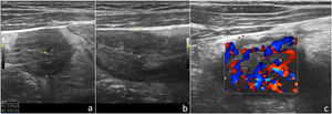 Corte longitudinal (a) y transversal (b) con sonda lineal de alta frecuencia (8-12MHz) a nivel de fosa iliaca derecha donde se identifica el íleon terminal con engrosamiento generalizado de su pared y cuantificación de su espesor. c) Imagen similar a la primera donde se evidencia un aumento de la vascularización del íleon mediante Doppler color.