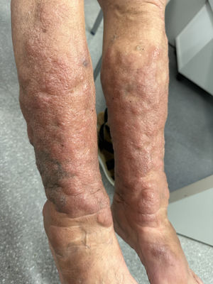 Mixedema pretibial. Piernas en piel de naranja.