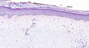 Biopsia con depósitos extensos de mucina en dermis papilar y atrofia epidérmica con infiltrado inflamatorio perivascular. Tinción hematoxilina-eosina (40 ×).