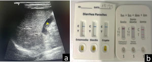 a) Imagen ecográfica obtenida con sonda lineal de alta frecuencia (8-12MHz), con convexo virtual, mediante corte longitudinal del abdomen a nivel de la línea medio clavicular derecha, donde se identifica la vesícula biliar (*) con discreto engrosamiento mural. b) TDR parasitarios y víricos con positividad para EH y astrovirus.