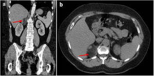 a) Corte coronal. b) Corte axial. a y b) TC de abdomen que sitúa la glándula suprarrenal izquierda de forma y tamaño normal, con tumoración sólida redondeada bien definida de 53×46mm con UH de -33 en la suprarrenal derecha.