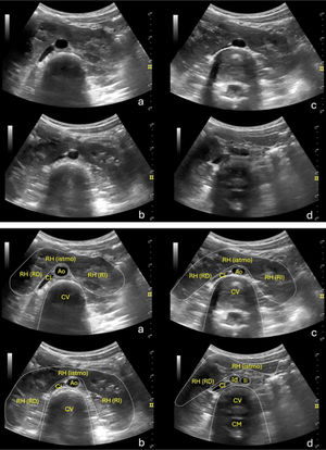 Cortes ecográficos donde se visualiza el RH (arriba) con identificación de las diferentes estructuras (abajo). a)Corte transversal del abdomen a nivel de la línea media de epigastrio inferior, donde se visualiza el istmo (RH [istmo]) del riñón en herradura (RH), que une a ambos riñones por sus polos inferiores (derecho: RH-RD; izquierdo: RH-RI). Inmediatamente debajo del mismo se visualizan dos estructuras anecogénicas, una de morfología circular, que corresponde a la aorta descendente (Ao), y otra fusiforme, de disposición oblicua y a la izquierda de la anterior, que corresponde a la vena cava inferior (CI). b)Corte similar al anterior, inmediatamente debajo del mismo, donde se expone un mayor espesor de ambos riñones. c)Corte similar a nivel de mesogastrio, donde la Ao comienza a dividirse en las dos arterias iliacas. d)Corte inmediatamente debajo del anterior, donde se visualiza la porción inferior del istmo y polo inferior del RD (más caudal que el contralateral) y las dos arterias iliacas (Id: derecha; Ii: izquierda) tras la bifurcación de la Ao. CM: canal medular; CV: cuerpo vertebral.
