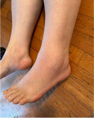 Edema bilateral maleolar.