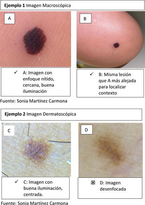 Ejemplos de captura de imágenes de manera correcta e incorrecta. Ejemplo 1: imagen macroscópica. Ejemplo 2: imagen dermatoscópica. Fuente: Sonia Martínez Carmona.