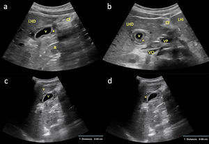 a) Corte longitudinal paramedial del abdomen a nivel de hipocondrio derecho con sonda convex (1,5-4,5MHz), en el que se objetiva una sección sagital de la vesícula biliar (VB) con pared engrosada (*), sugerente de CAA; b) Corte transversal del abdomen con la misma sonda y al mismo nivel que el anterior, en el que se visualiza una sección axial de la VB con pared igualmente engrosada (*); c y d) Cuantificación del grosor mural vesicular (*) en un corte longitudinal paramedial del abdomen a nivel de hipocondrio derecho con sonda convex, en el que se observa una sección sagital de la VB con pared engrosada: c) 6,6mm; d) 8,6mm (normal <3mm). CF: cisura falciforme; LHD: lóbulo hepático derecho; LHI: lóbulo hepático izquierdo; R: riñón derecho; VCI: vena cava inferior; VP: vena porta.