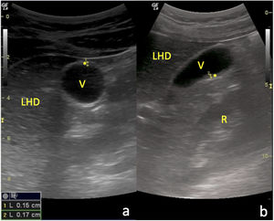 Resolución estructural de la CAA: a) Corte transversal del abdomen a nivel de hipocondrio derecho con sonda convex, en el que se objetiva una sección axial de la VB con pared de morfología y grosor normales (*); b) Corte longitudinal paramedial del abdomen con la misma sonda y al mismo nivel que el anterior, en el que se visualiza una sección sagital de la VB con pared igualmente normal (*). LHD: lóbulo hepático derecho; R: riñón derecho.