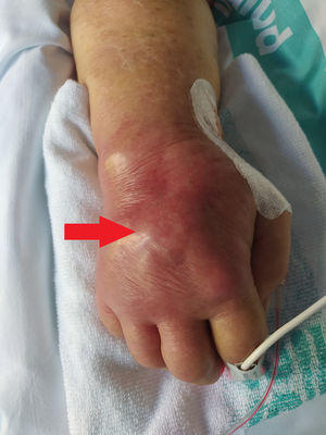 Tenosinovitis infecciosa. Visión directa del dorso de la mano derecha de la paciente, enrojecida y tumefacta como signo indirecto de tenosinovitis subyacente.