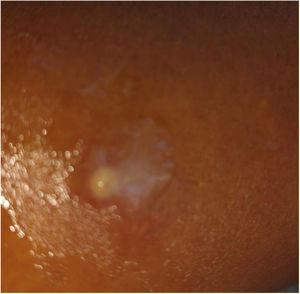 Lesión cutánea con un punto central.