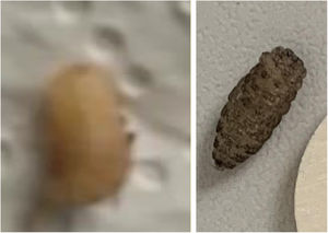 Larva causante de una miasis extraída del cuerpo humano.