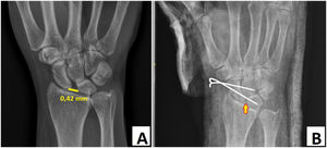 A) Radiografía de mano y muñeca con ensanchamiento de espacio escafolunar de> 4mm (patológico> 2mm). B) Radiografía de mano y muñeca tras la reducción abierta con agujas e inmovilización con yeso (se visualiza normalización del espacio escafolunar -flecha-).