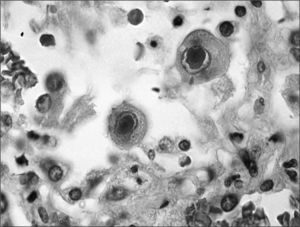 Cytomegalic inclusions in cytomegalovirus-infected cells.