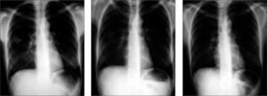 Radiografía de tórax. Resolución de la imagen radiológica,