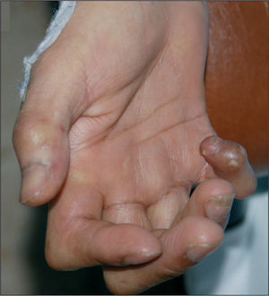 Mano derecha en garra con atrofia de eminencia hipotenar y anquilosis del cuarto y quinto dedo.