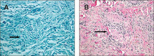 Examen anatomopatológico de la piel que muestra restos de bacilos ácido-alcohol resistentes en el interior de los macrófagos (A) (Ziehl, x100) y un infiltrado granulomatoso y linfocitario que infiltra un nervio cutáneo (B) (hematoxilina-eosina, x40).