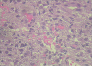 Mucosa gástrica. Corión ocupado por histiocitos cargados de esporas de 3-4 μ. Tinción de hematoxilina-eosina.