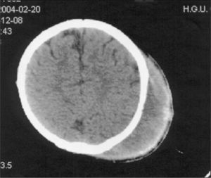 Tomografía craneal: presencia de lesión parietal izquierda de 9 x 7 x 2,5 cm compatible con hemorragia subgaleal, sin líneas de fractura.