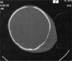 Tomografía craneal: adelgazamiento del diploe craneal adyacente con cambios asociados al hematoma.