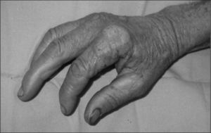 Tuberculosis verrucosa en dorso de la mano.