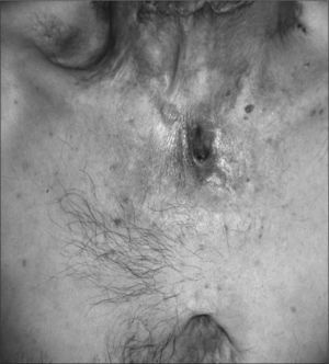 Escrofuloderma con foco tuberculoso óseo subyacente a nivel esternal.