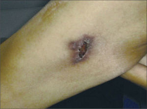 Lesión ulcerocostrosa en el brazo derecho de aproximadamente 2 cm de diámetro.