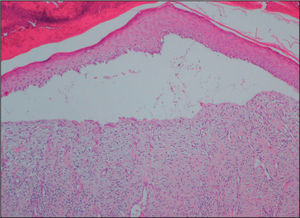 Biopsia de piel con coloración de hematoxilina-eosina: epidermis adelgazada con gran ulceración por despegamiento dermoepidérmico.