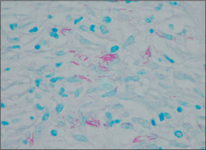 Examen histopatológico de la biopsia cutánea con coloración de Ziehl-Neelsen: conglomerados de bacilos ácido-alcohol resistentes.