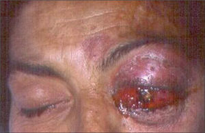Panoftalmitis en ojo izquierdo observado en sala de urgencias. Se observa proptosis, quemosis, edema y enrojecimiento del ojo con necrosis del anillo corneal sugestivos de infección bacteriana.