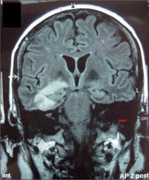 RM cerebral: área de cerebritis en el temporal central y medial derecho.