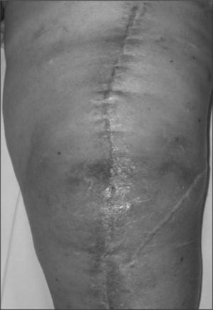 Celulitis en el área de la herida quirúrgica en un paciente intervenido unas semanas antes de una artroplastia de rodilla. Es indicativa de infección posquirúrgica precoz.
