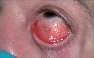 Edema palpebral, hiperemia y secreción conjuntival en el ojo izquierdo.