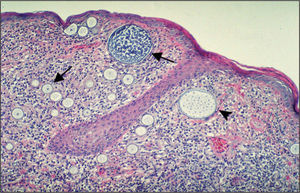 Mucosa conjuntival con numerosos organismos esféricos polimorfos en el corion, rodeados por un denso infiltrado inflamatorio crónico (HE, ×40).