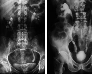 Dos ejemplos de imágenes de urografía que muestran estadios avanzados de tuberculosis con amputaciones y cavitaciones de los cálices, estenosis y dilatación ureteral y disminución del tamaño de la vejiga urinaria.