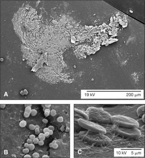 Hallazgos microscópicos en las endoftalmitis crónicas. A) Mediante microscopía electrónica de barrido, se observa la formación de una biopelícula bacteriana sobre la superficie de una lente intraocular explantada en un caso de endoftalmitis de aparición tardía. B) En este caso, la biopelícula presentó característica heterogénea y de baja adhesividad formada por células cocoidales sugestiva de una infección por Staphylococcus spp. En la parte superior izquierda de la microfotografía, se puede observar la deposición de hexapolisacáridos de adhesión sobre la matriz extracelular de la superficie de la lente intraocular, producidos por los propios microorganismos que conforman la biopelícula. C) En otras ocasiones, la biopelícula presentó característica homogénea y de alta adhesividad constituida por la presencia de bacterias filamentosas, sugestivas de una contaminación por hifas. Asimismo, se pudo observar la presencia de algunos hematíes asociados a la biopelícula. A, barra: 200 μm; B y C, barra: 5 μm.