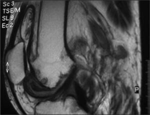 Imagen de resonancia magnética en la que se observa la importante proliferación de la membrana sinovial, así como las lesiones condrales y óseas asociadas.