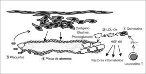Patogenia de la arteriosclerosis y su relación con la infección por Chlamydophila pneumoniae (II). (1) La quineurina reduce la salida de C. pneumoniae y aumenta la expresión de la proteína de choque térmico 60 (HSP 60). (2) Los macrófagos infectados engloban las lipoproteínas de baja densidad (LDL) y se transforman en células grasas. (3) Las plaquetas agregadas liberan un factor de crecimiento celular que hace proliferar un músculo liso indiferenciado que libera colágeno, elastina y proteoglucanos con formación de tejido fibroso. (4) Se forma la placa madura con un core de lípidos y colesterol rodeada de una capa fibrosa.