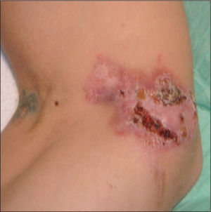 Lesión ulcerada, eritemato-costrosa en la cara externa del muslo.