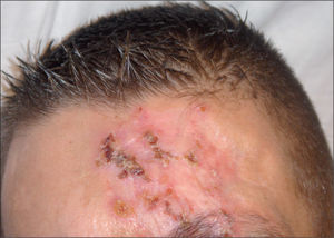 Lesión ulcerada, eritemato-costrosa en la zona frontal.