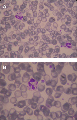 Tinción de May-Grünwald-Giemsa de un frotis de sangre periférica. Obsérvense las pequeñas estructuras del interior de los neutrófilos. A) ×400; B) ×1.000.