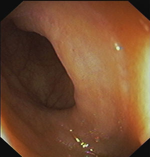 Colonoscopia en la que se aprecia mucosa intestinal sin alteraciones macroscópicas.