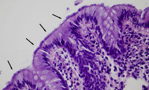 Pieza de biopsia de colon en la que se aprecia una «falsa barrera epitelial» (señalado con varias flechas) en el borde en cepillo de la mucosa intestinal (HE, ×200).