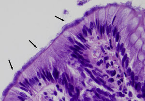 Detalle de pieza de biopsia de colon en el que se observan más claramente bacterias filamentosas dispuestas sobre el polo luminal del epitelio superficial del colon (HE, ×400).