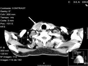Tomografía computarizada de cuello con contraste en la que se aprecia lesión hipodensa dependiente de lóbulo tiroideo derecho.