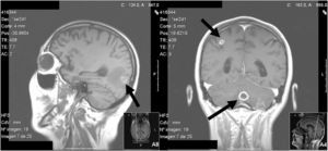 Resonancia magnética encefálica T1 con contraste. Se aprecian 3 lesiones localizadas en lóbulo parietal, occipital y cerebelo, redondeadas que captan contraste en anillo. La lesión occipital con edema perilesional.