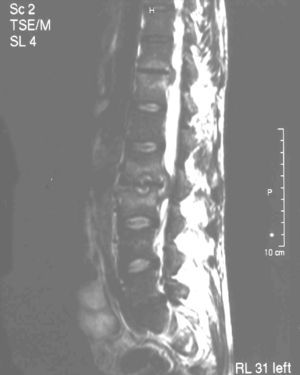 Spinal MRI. D11–D12 and L2–L3 disc lesions suggestive of spondylitis.