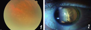 Fondo de ojo en el que se aprecian focos de coriorretinits y vitritis grave. Figura 2. Cámara anterior en la que se observan haces de fibrina blanquecinas. Efecto Tyndall muy positivo (3+).