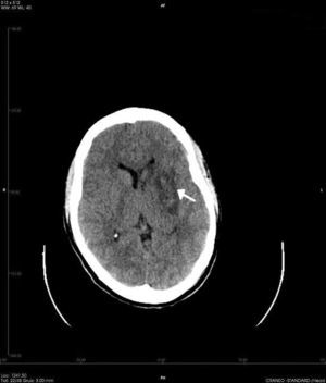 Tomografía computarizada craneal: infarto del territorio profundo de la arteria cerebral media izquierda.