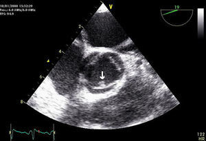 Ecocardiografía transesofágica: imagen nodular móvil de 5mm en el borde de la valva no coronárica de la válvula aórtica.
