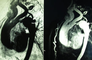 Coartación de aorta en el istmo aórtico, con imagen de estenosis de aproximadamente 1,42cm de diámetro y dilatación postestenótica de morfología sacular, con un diámetro aproximado de 3,5cm.
