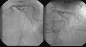 Arteriografía coronaria, antes del episodio de endocarditis (izquierda) y tras el infarto agudo de miocardio producido durante la endocarditis (derecha). Se aprecia amputación de la arteria diagonal (d), no presente previamente. DA: arteria descendente anterior.
