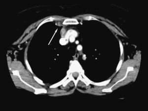Sección tomográfica donde se evidencia el aumento del tamaño de la vena mamaria derecha indicativa de trombosis (flecha).